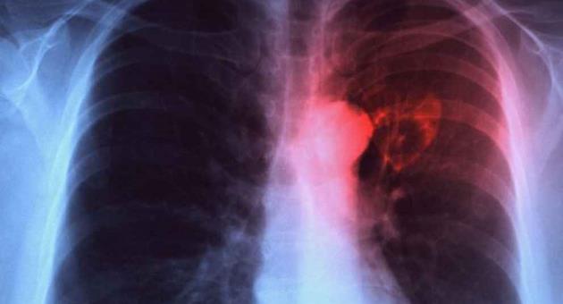 نتيجة بحث الصور عن ‪Tuberculosis- TB‬‏